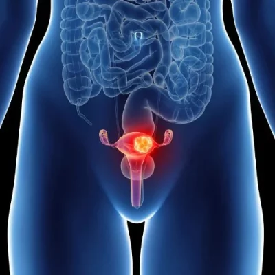 Polycystic ovary syndrome Polycystic ovary syndrome